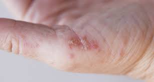 Atopijski dermatitis – začarani krug svrbeža kože