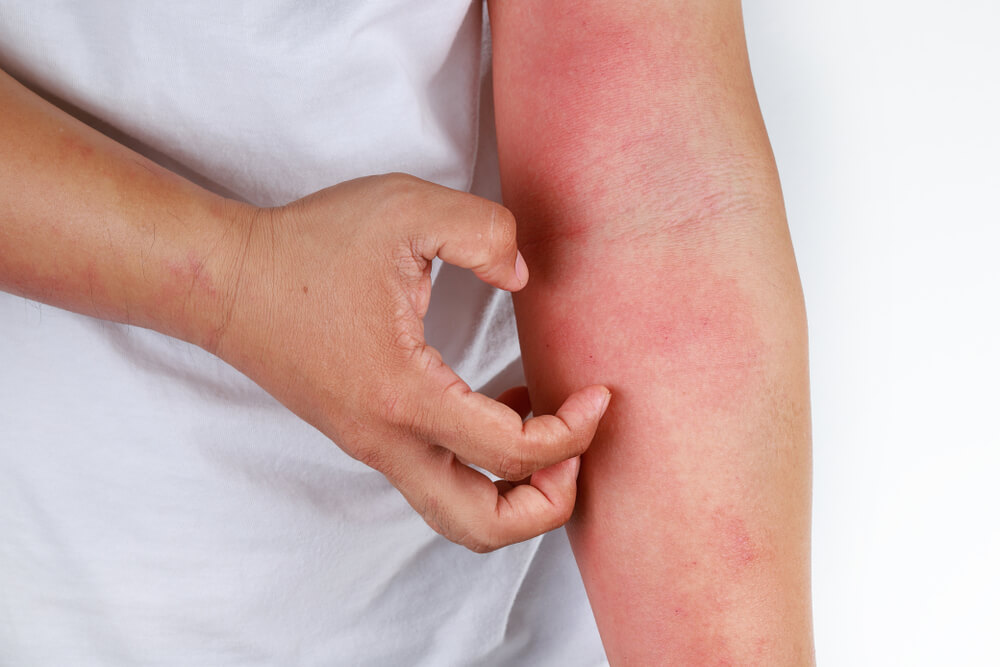 Atopijski dermatitis – crvena koža koja svrbi