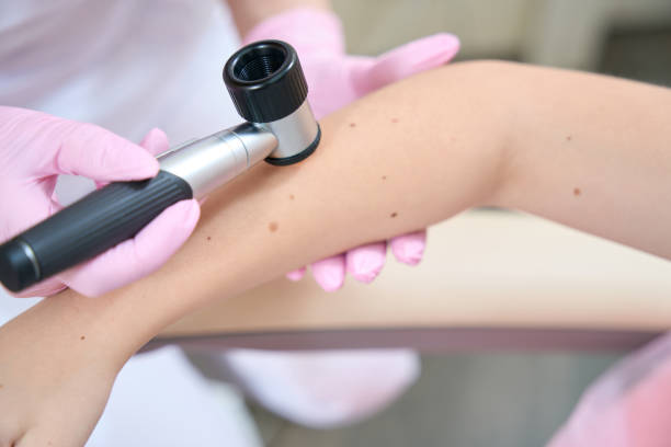 Dermatoskopija madeža – zašto je važna i kada ju treba napraviti?