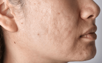 Inovativno rješenje za ožiljke od akni: lasersko obnavljanje kože