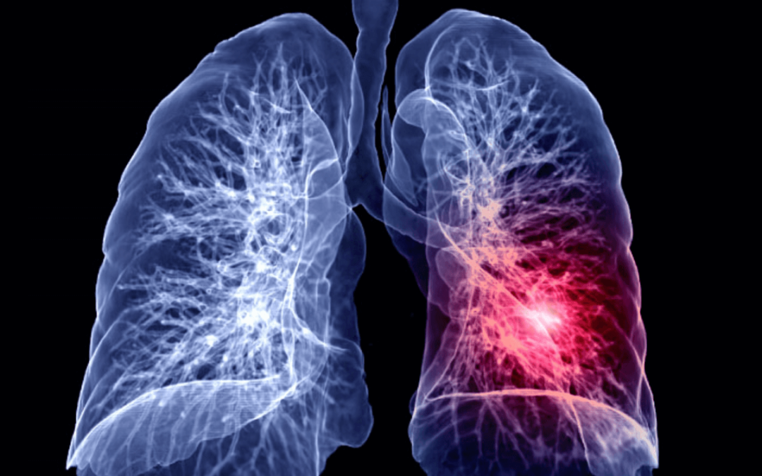 Rizični čimbenici za plućnu emboliju