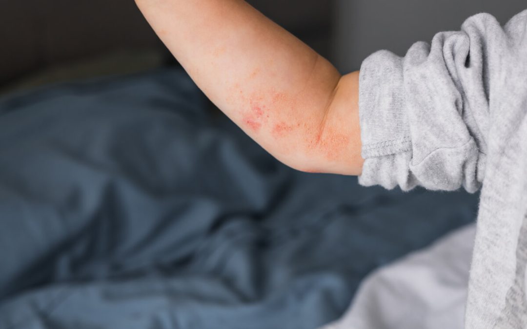 Što je atopijski dermatitis?