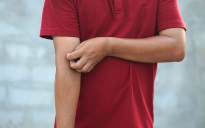 Kako prepoznati svrab – glavni simptomi