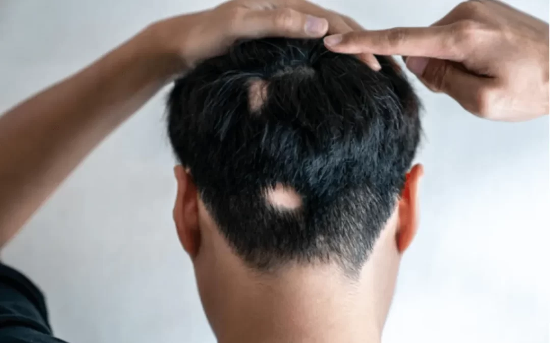 Alopecija i psihološki utjecaj gubitka kose – ono o čemu se rijetko govori