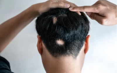 Alopecija i psihološki utjecaj gubitka kose – ono o čemu se rijetko govori