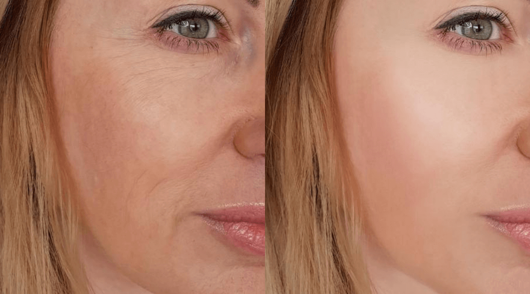 Nova definicija elegancije: zašto bore oko usana više nisu tabu tema